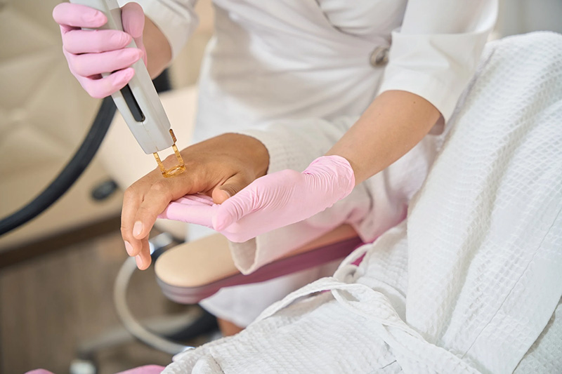Client at a laser hair removal session for the hand